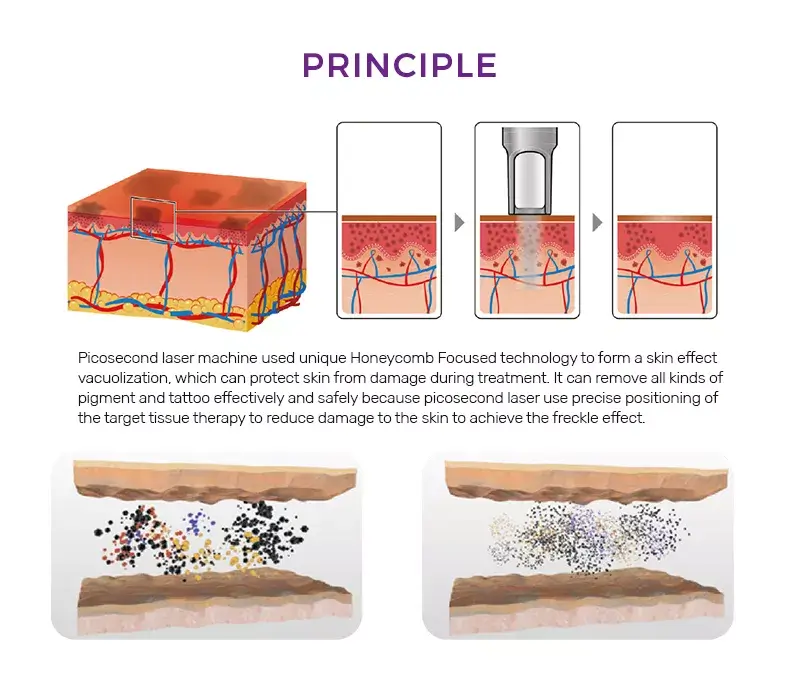 pico laser how it works process