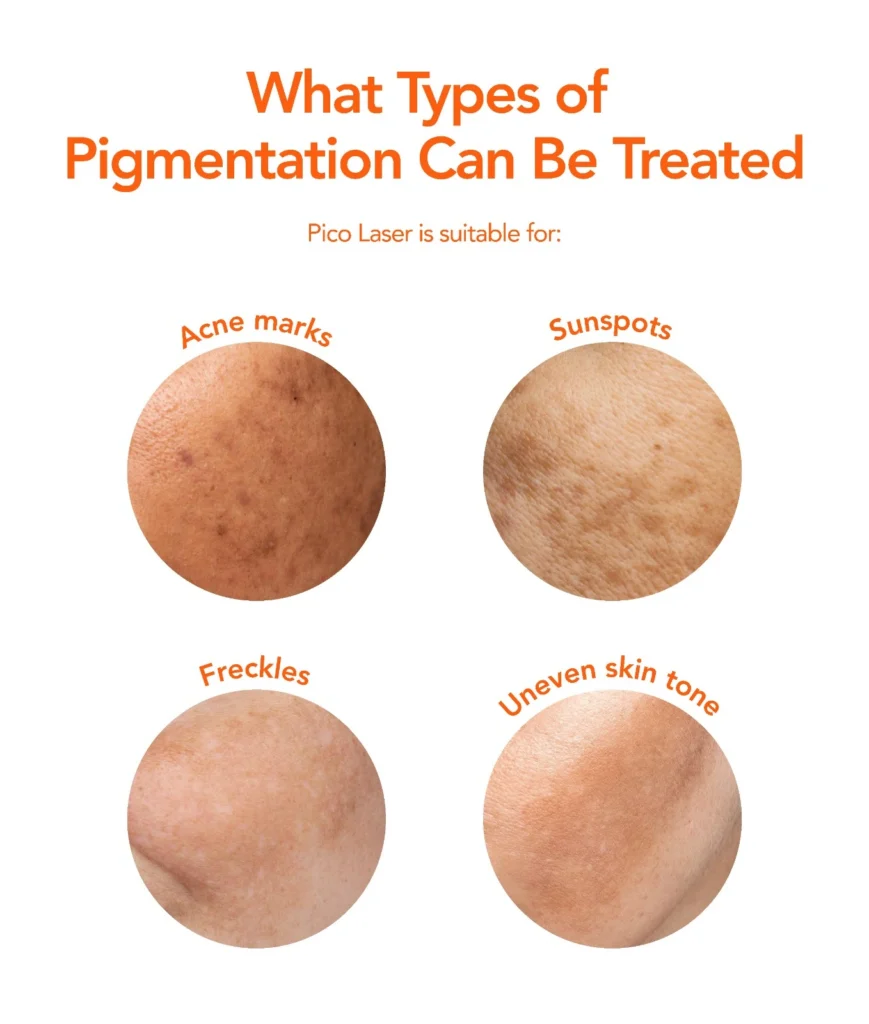 laser pigmentation
